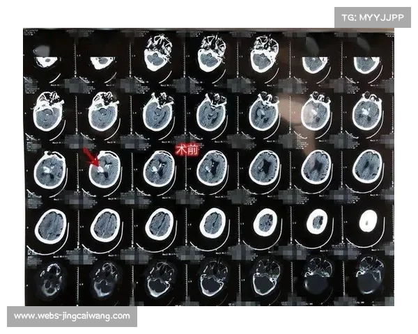 佐佐木尽CT扫描排除脑出血,短暂失忆六周后已出院恢复 佐佐木尽CT扫描排除脑出血,短暂失忆六周后已出院恢复